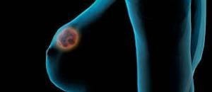 Mulheres devem fazer auto-exame do cancro da mama 